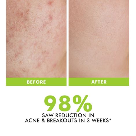 Conscious Chemist Flashfix Acne Spot Corrector Face Cream With 2% Salicylic Acid & Bio-Actives