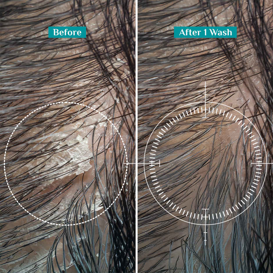 Pilgrim Tea Tree Non-Drying Anti-Dandruff Shampoo Helps remove Dandruff for Men & Women