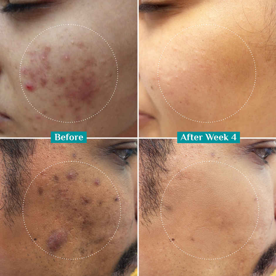 Pilgrim 10% Niacinamide Serum For Acne Marks