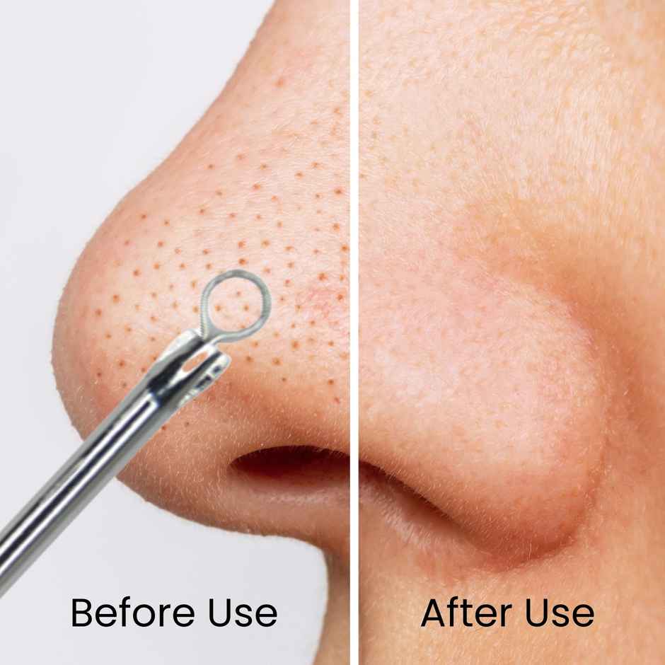 Midazzle Stainless Steel Blackhead & Whitehead Remover Face Care Tool | MIBR3301