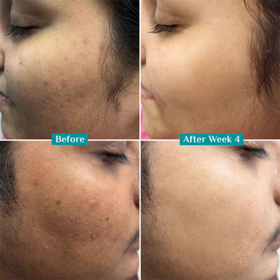 Pilgrim 10% Niacinamide Face Serum with Kojic Acid for Acne Marks, Clear & Glowing Skin