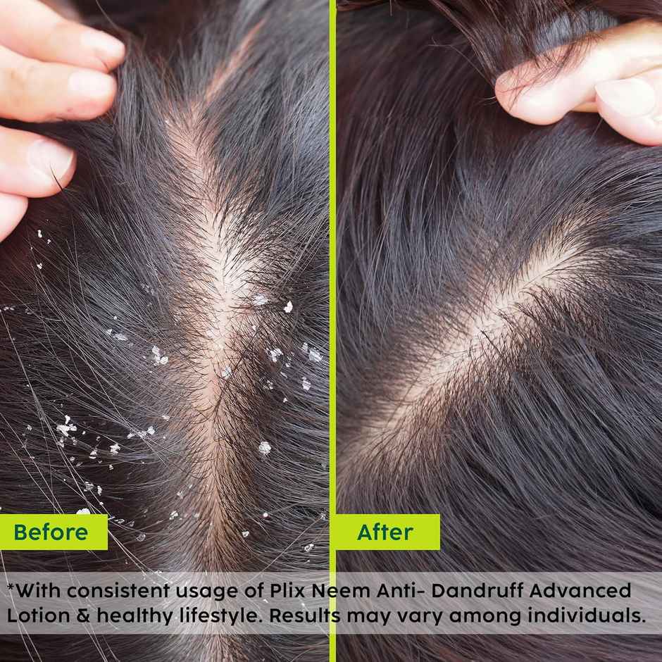 Plix The Plant Fix Neem Anti-Dandruff Advanced Lotion | Reduces Dandruff | Itchy Scalp