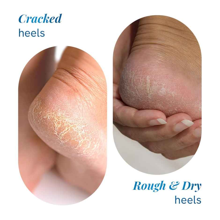 Be Bodywise 20% Urea Foot Cream Roll On | For Dry & Cracked Heels