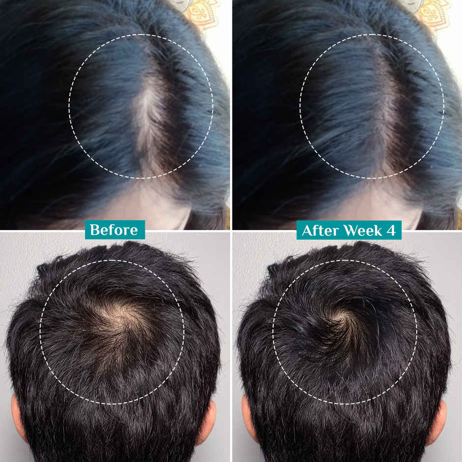 Pilgrim Advanced Hair Growth Serum with Redensyl & Anagain Reduces Hair Fall & Boosts Hair Growth