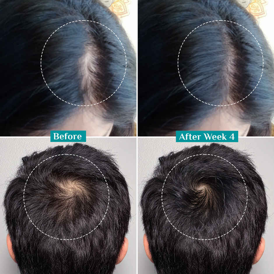 Pilgrim Redensyl & Anagain Advanced Hair Growth Serum, Controls Hairfall & Increase Hair Groeth