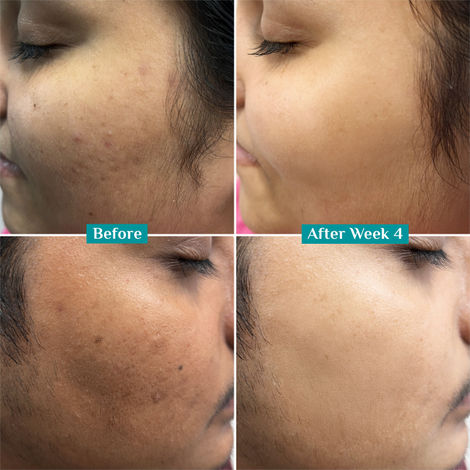 Pilgrim 10% Vitamin C Face Serum For Daily Brightness Helps Reduce Dark Spots & Evens Skin Tone