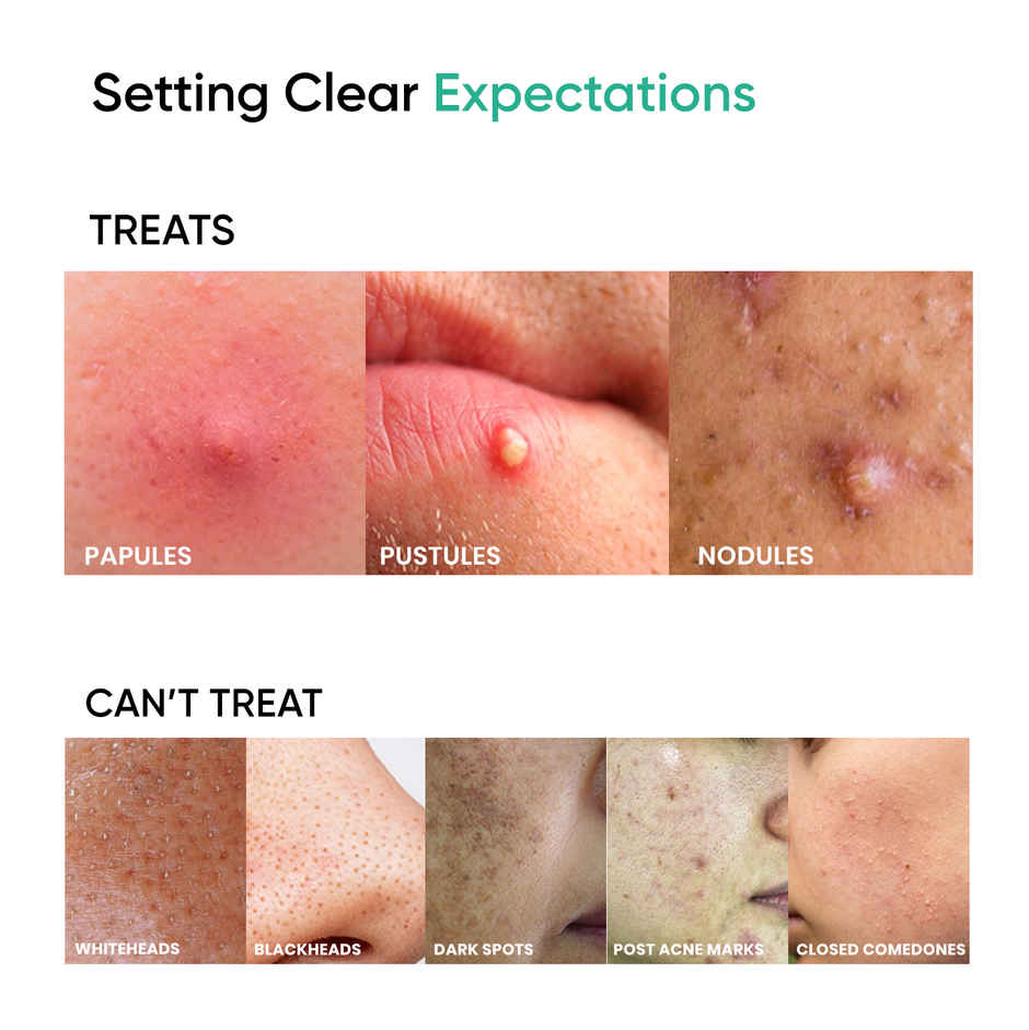 SkinInspired AcNil3 Acne Spot Corrector