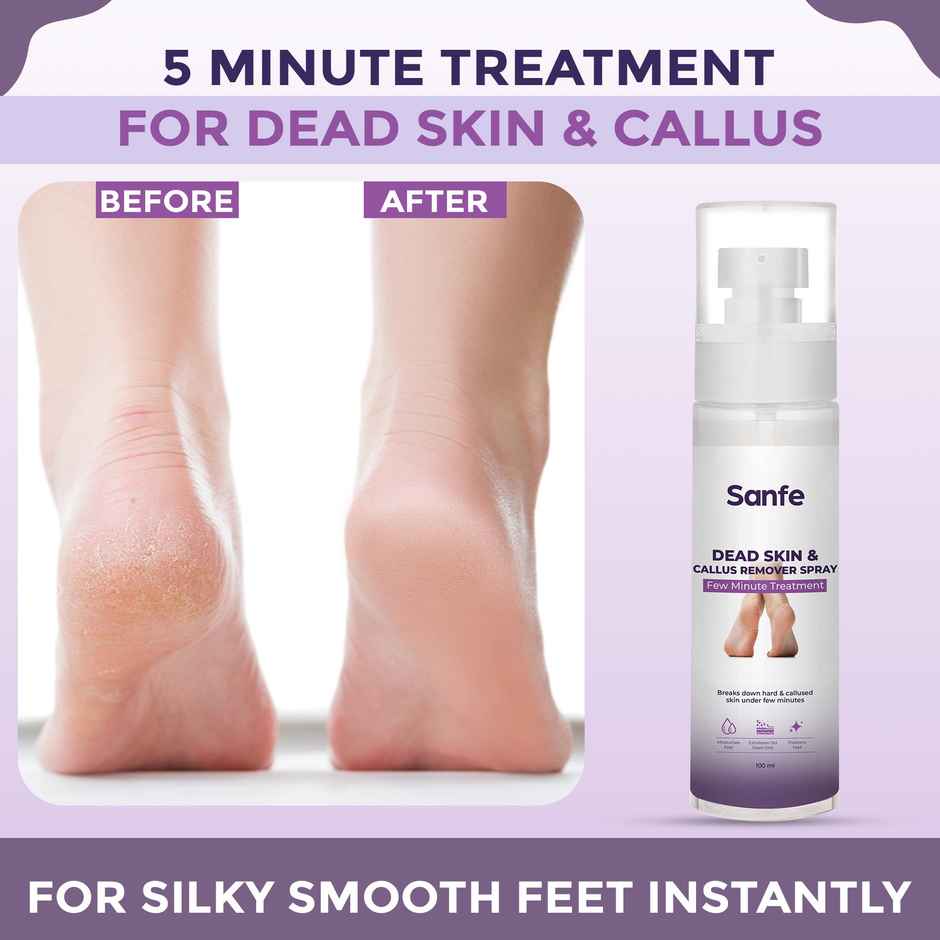 Sanfe Dead Skin & Callus Remover Spray Freshens, Exfoliates - For Dry & Cracked Feet