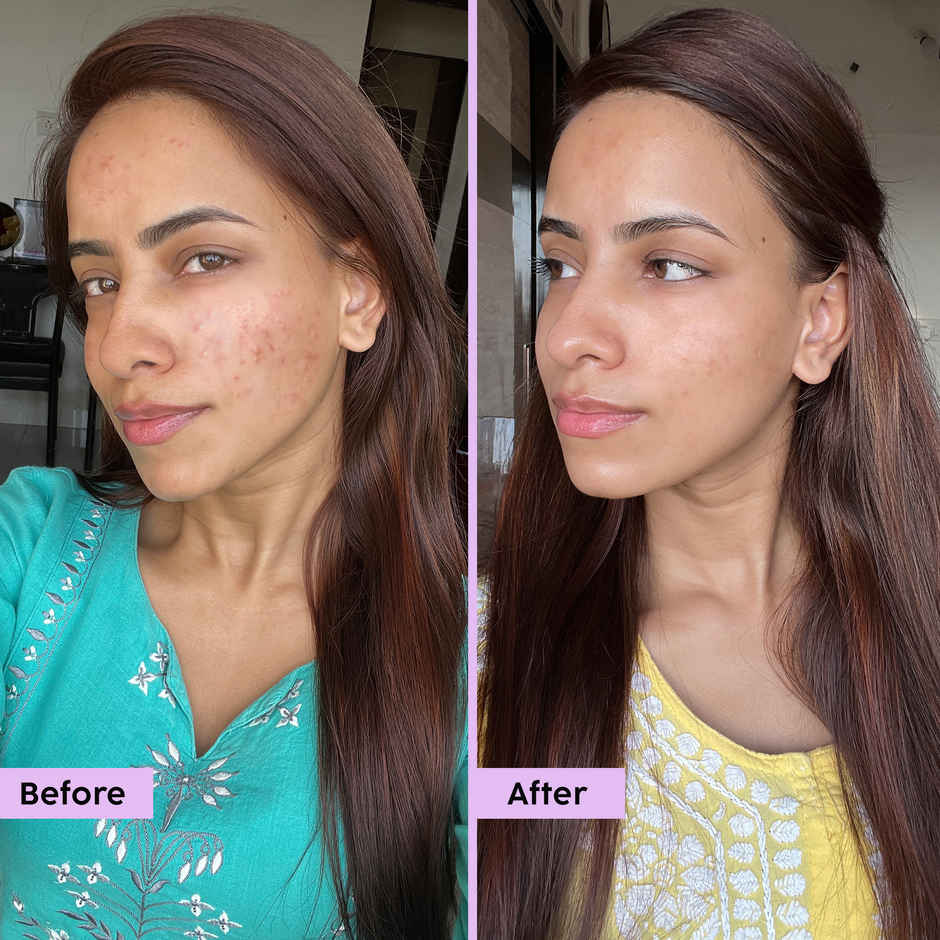 Plix The Plant Fix Jamun Face Wash and Active Acne Serum Combo For Active Acne & Oil Control