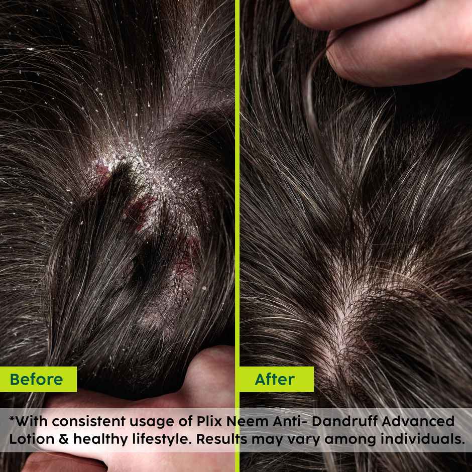 Plix The Plant Fix Neem Anti-Dandruff Advanced Lotion | Reduces Dandruff | Itchy Scalp