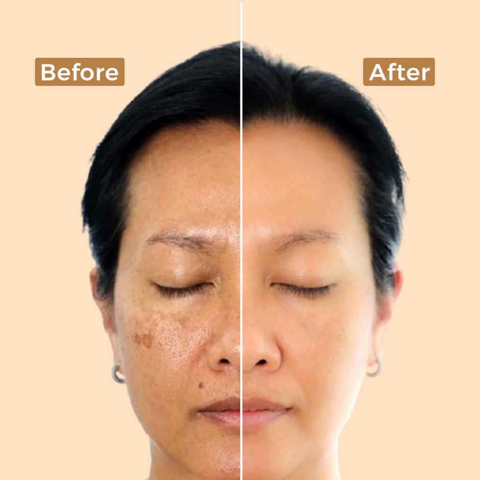 Indus Valley Depigmentation Gel