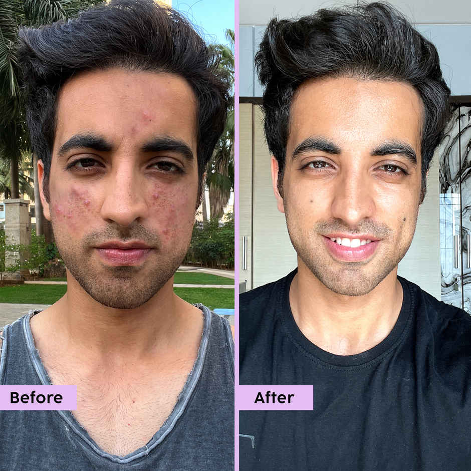 Plix The Plant Fix Jamun Face Wash and Active Acne Serum Combo For Active Acne & Oil Control