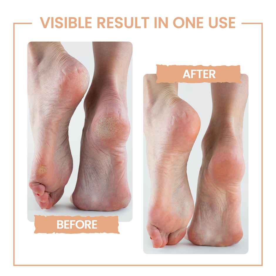 PROTOUCH Bliss Callus Remover | Electric Home Pedicure Device For Smooth Feet