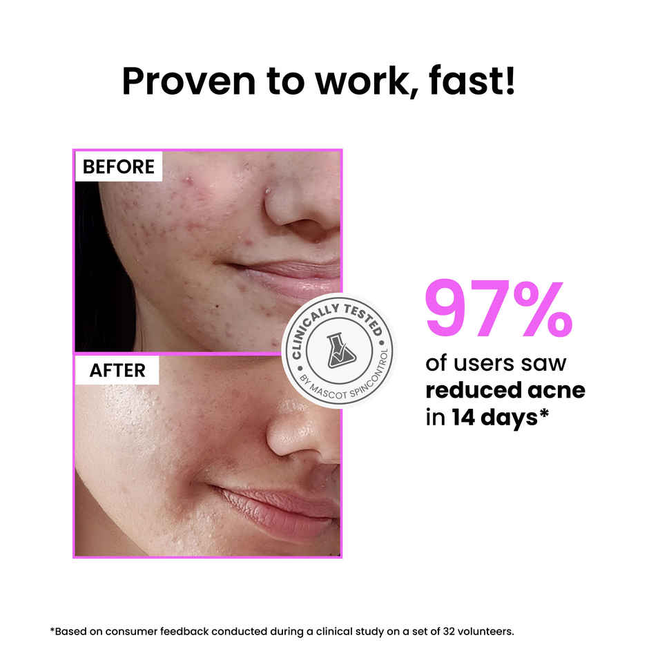 Foxtale 12% Niacinamide Face Serum with Azelaic Acid | Reduces Acne & Blemishes