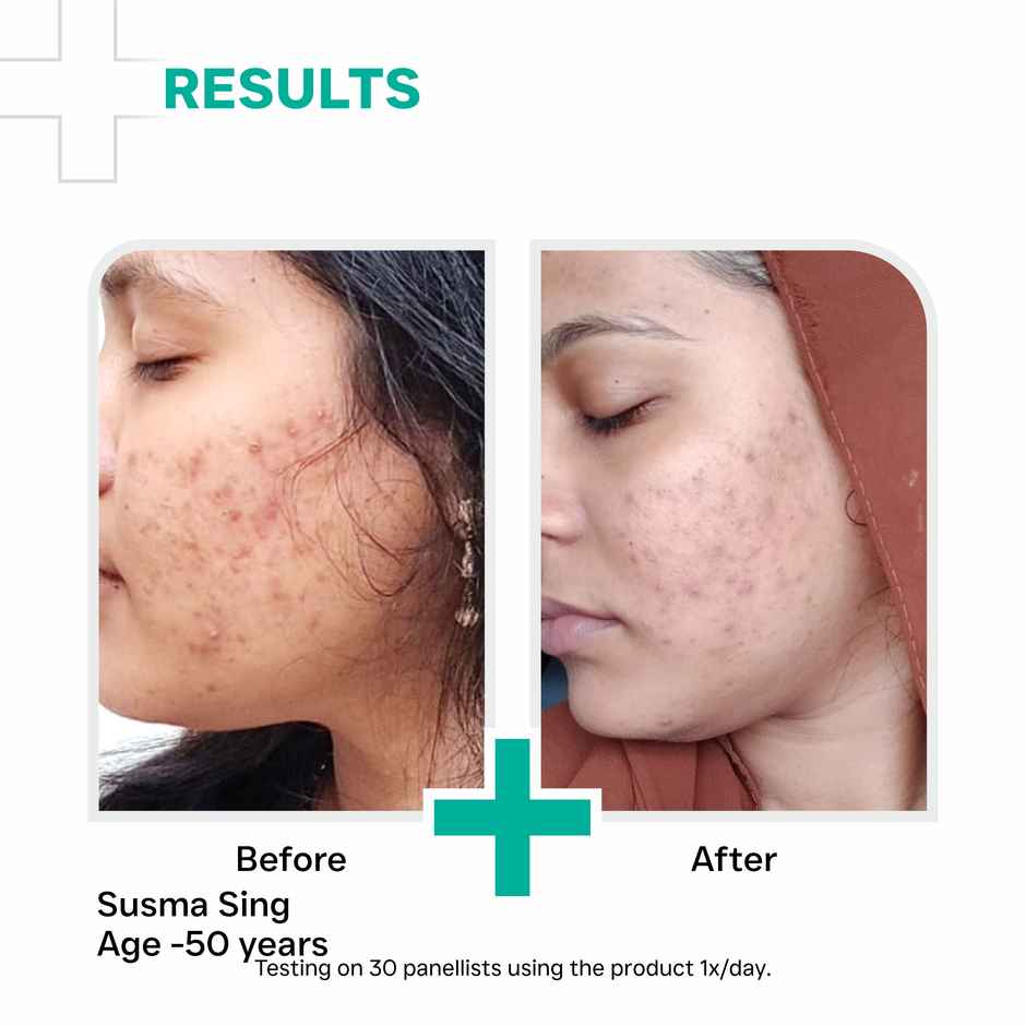 Dermatouch Salicylic Acid 2% Niacinamide 6% Anti-Acne Oil-Free Gel For Active Acne