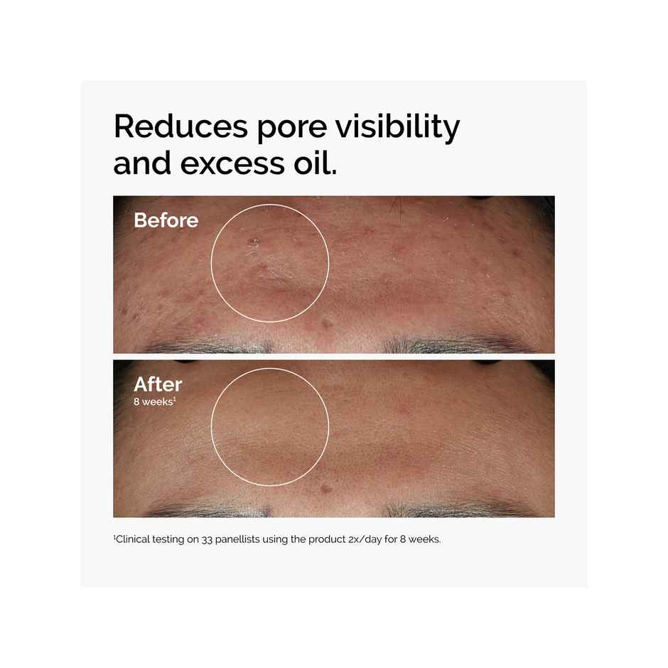 The Ordinary Niacinamide 10% + Zinc 1% (60ml) & The Ordinary Squalane Cleanser (50ml) & The Ordinary Squalane + Amino Acids Lip Balm (15ml) Combo