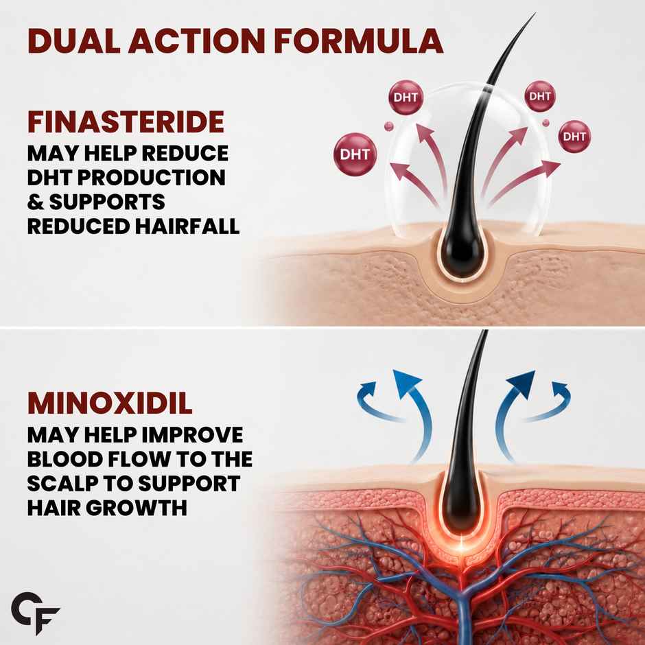 Carbamide Forte Minoxidil 5% & Finasteride 0.1% Topical Solution for Men | Spray + Dropper