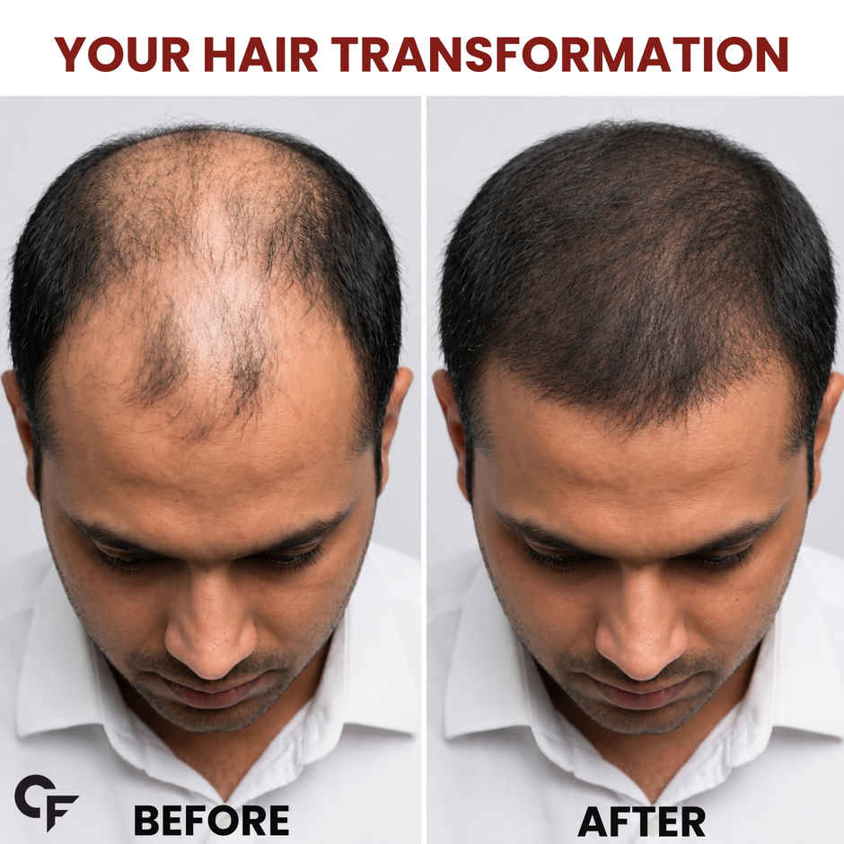 Carbamide Forte Minoxidil 5% & Finasteride 0.1% Topical Solution for Men | Spray + Dropper