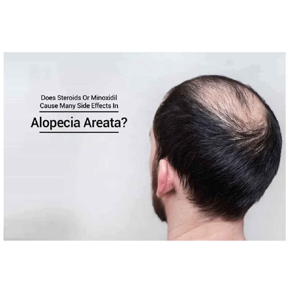 Minoqilib 5 Topical Solution