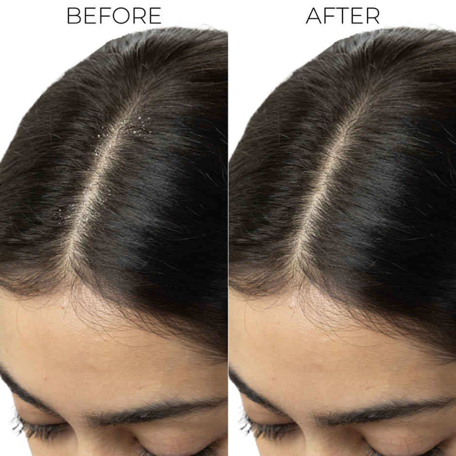 Brillare Dandruff Control Shampoo