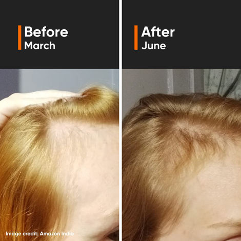 Minimalist Hair Growth Actives 18% Hair Serum