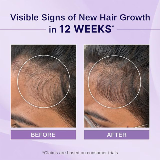 Bare Anatomy Rosemary Hibiscus Hair Growth Oil Nourishes, Strengthens & Controls Hair Fall