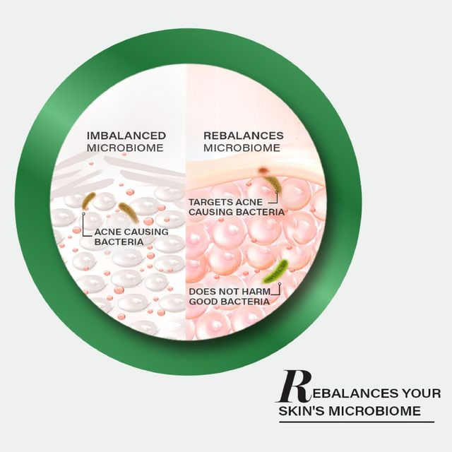 Novology Acne Serum | Face Serum For Acne | Whiteheads | Non-Sticky | Non-Comedogenic Formula