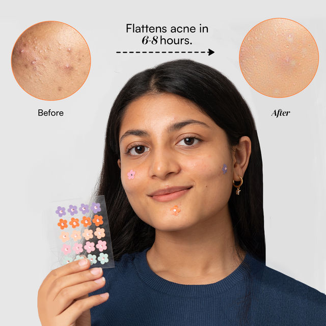 Gush Beauty Dart It Hydrocolloid Pimple Patches For Healing Acne Zits And Blemishes - Flower