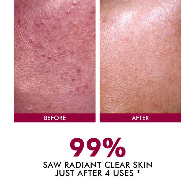 Conscious Chemist 25% AHA & 5% BHA Resurfacing Peeling Exfoliating Facial Serum For Anti-Aging