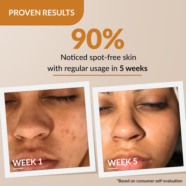 Fixderma Skarfix Plus Cream with 2% Kojic & 1% Arbutin | For Dark Spots & Pigmentation