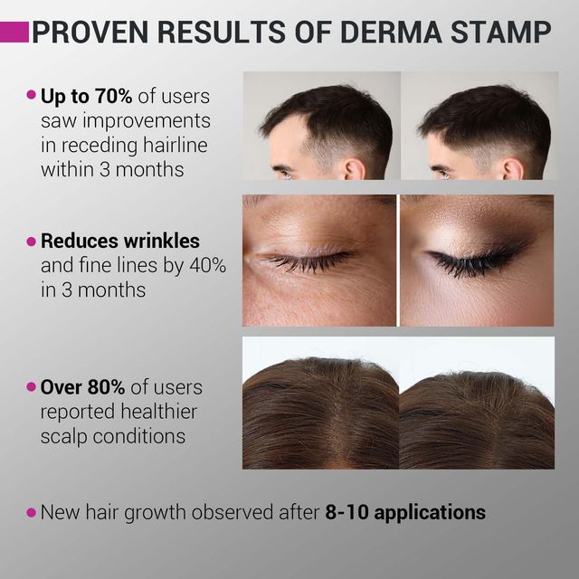 Sotrue Derma Stamp For Hair Growth & Collagen Boost Adjustable Needles - 0.25Mm To 3Mm